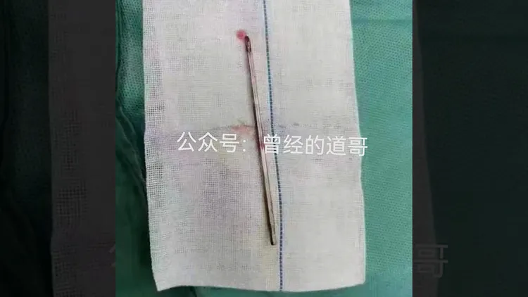 被取出的螺絲起子。翻攝自「曾經的道哥」微信