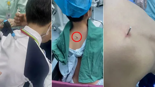 小學惡童「踢雞雞」霸凌 同學不忍了!螺絲起子狠刺背行兇