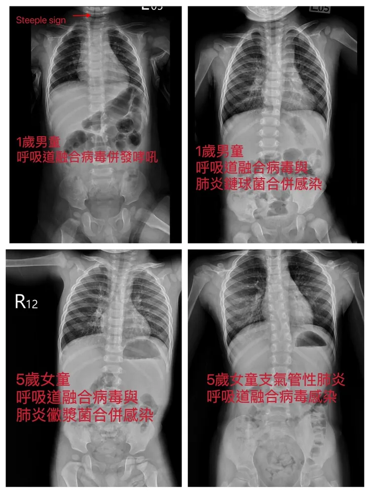 胸部Ｘ光。院方提供