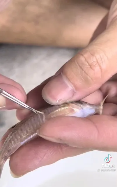 黃吸蟲被挑出，超噁的。