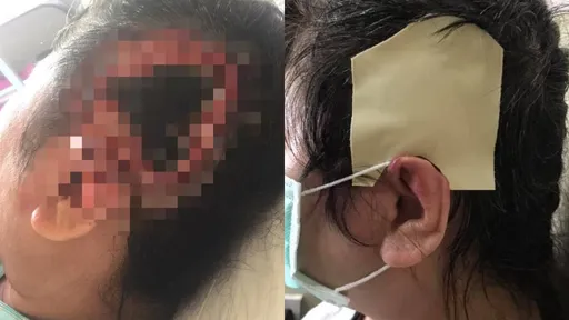恐怖！她電鍋燙髮竟燒傷成禿頭、耳朵缺角　設計師竟稱：別人都沒問題