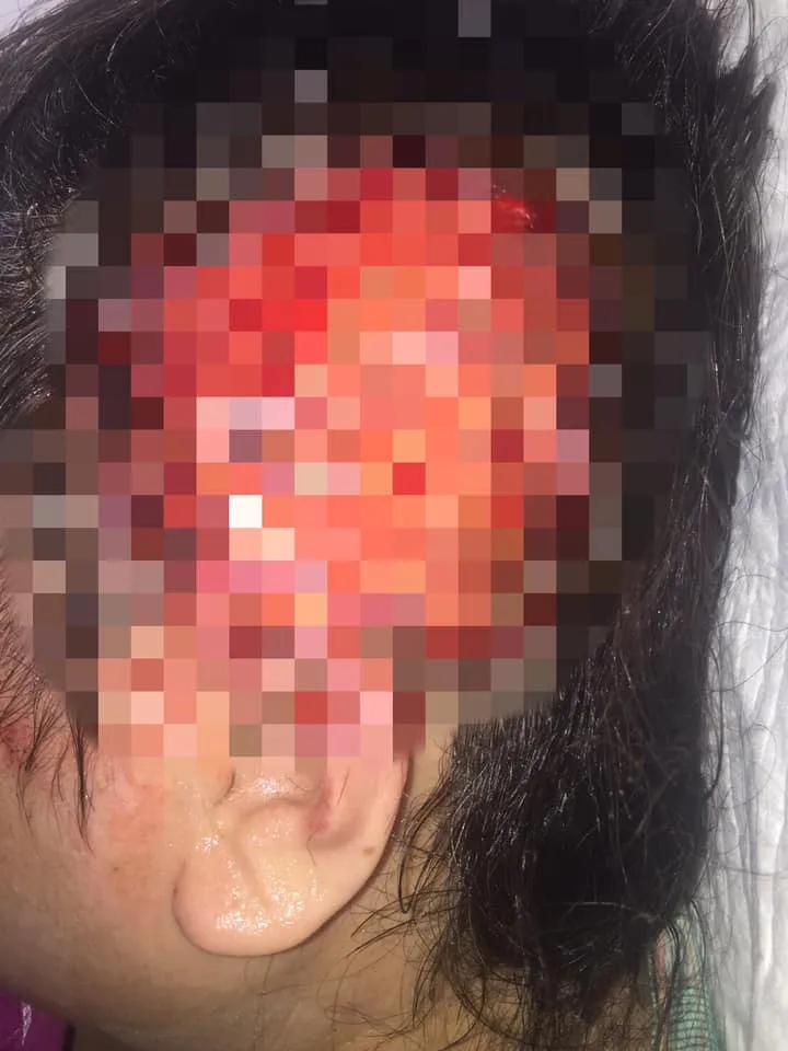 婦人三度燙傷。翻攝爆料公社二社