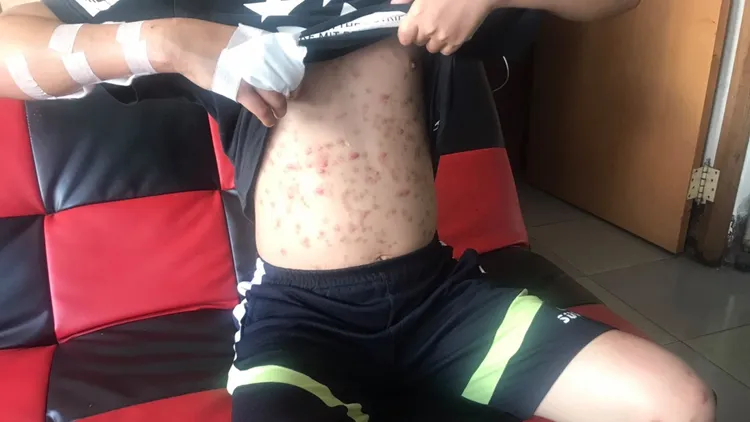 羅姓少年身上滿是BB彈擊中的傷痕。翻攝臉書「彰化人大小事」