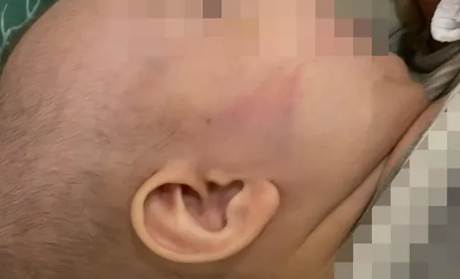 9月婴脸背处处瘀青 竟是恶保母嫌她哭闹下毒手