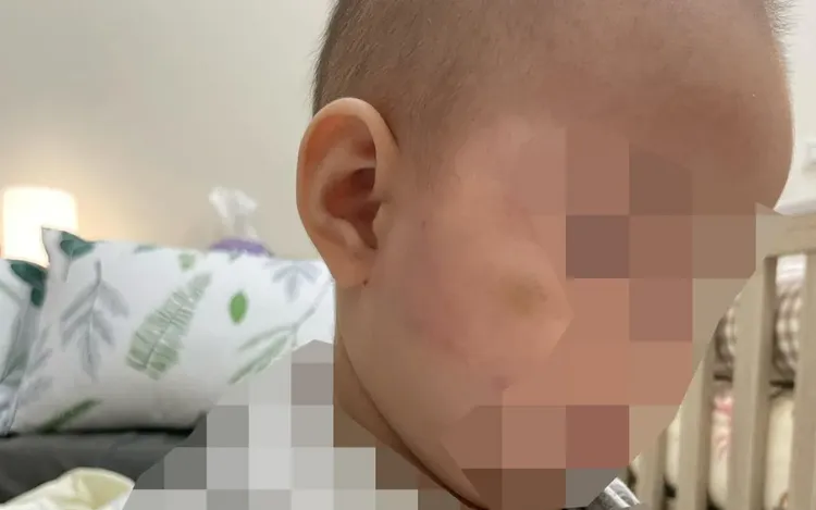 女嬰臉頰出現傷勢。翻攝《記者爆料網》