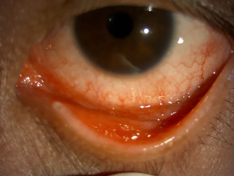 經過5天治療，少婦淋病結膜炎病況好轉，眼睛不再那麼紅腫。林昕穎醫師提供