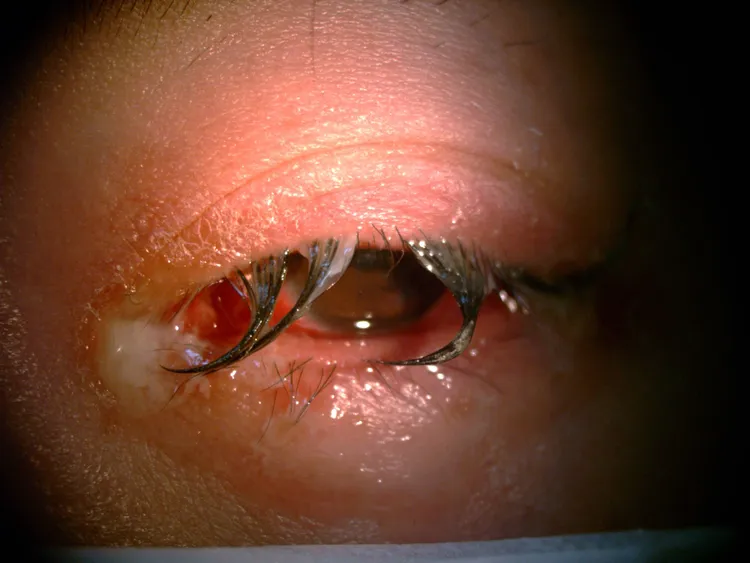 少婦左眼紅腫、分泌物多。林昕穎醫師提供