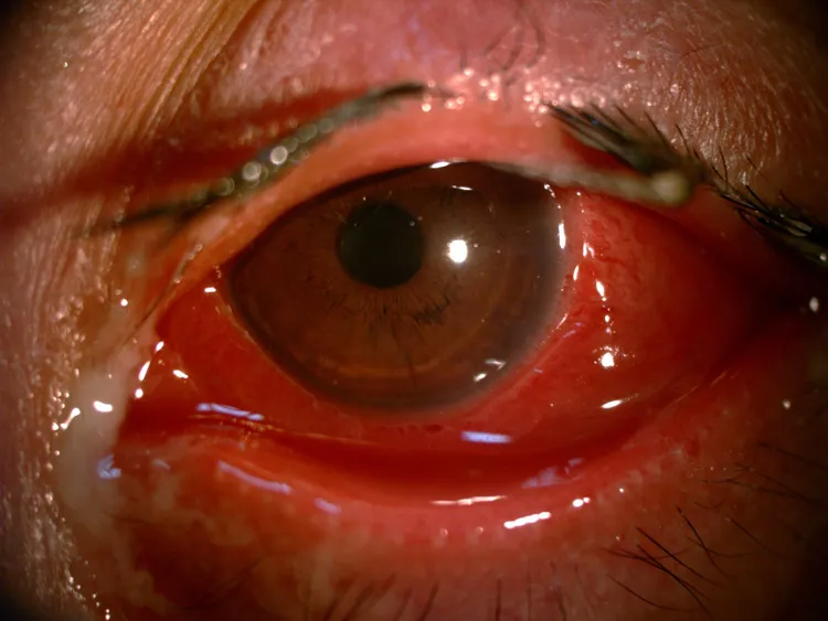 少婦染「淋病結膜炎 」，左眼紅腫、分泌物多。林昕穎醫師提供