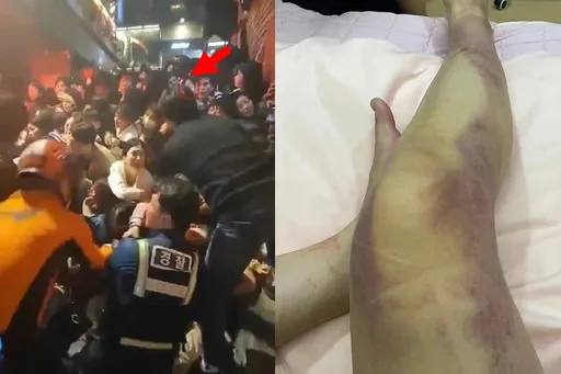 人壓人有多慘？梨泰院倖存女全腿黑青照曝！　目睹2女孩斷氣「再晚我也沒了」