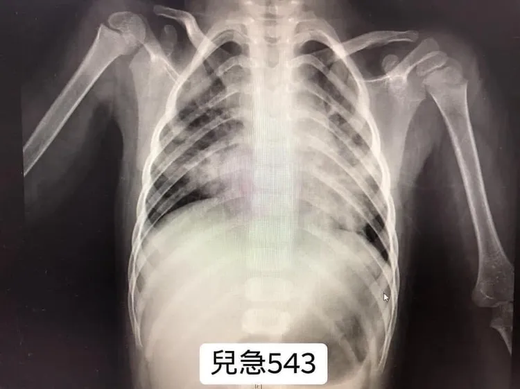 吳昌騰提醒家長們「RSV正在爆發中」。翻攝「來講兒科急診的543-吳昌騰醫師」臉書