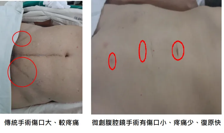 微創腹手術與傳統治療疝氣手術的比較。 大里仁愛醫院提供