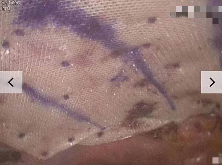 快黏式人工網膜及生化固定釘，可減低疝氣復發機會。大里仁愛醫院提供