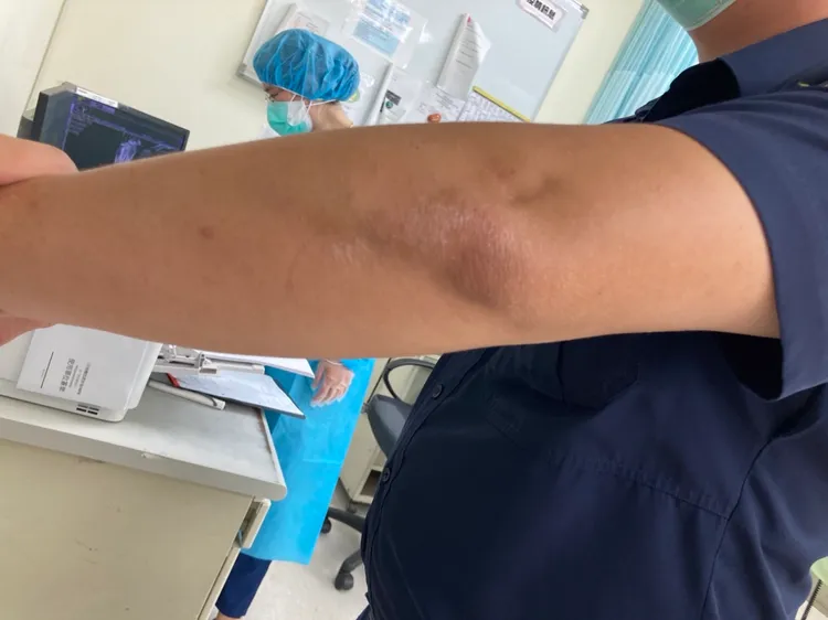 顏姓警員手部被醉打中輕微擦挫傷。讀者提供