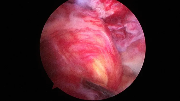 陳男膝關節鏡檢查前後十字韌帶都斷裂。大里仁愛醫唍提供