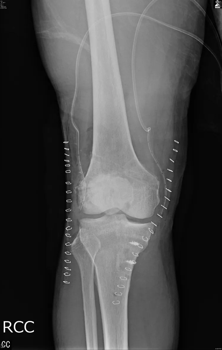 經手術後修復的膝關節。大里仁愛醫院提供