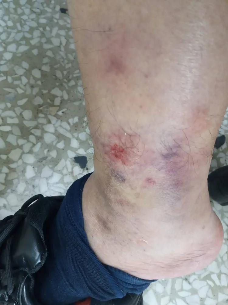 員警腳踝受傷。警方提供