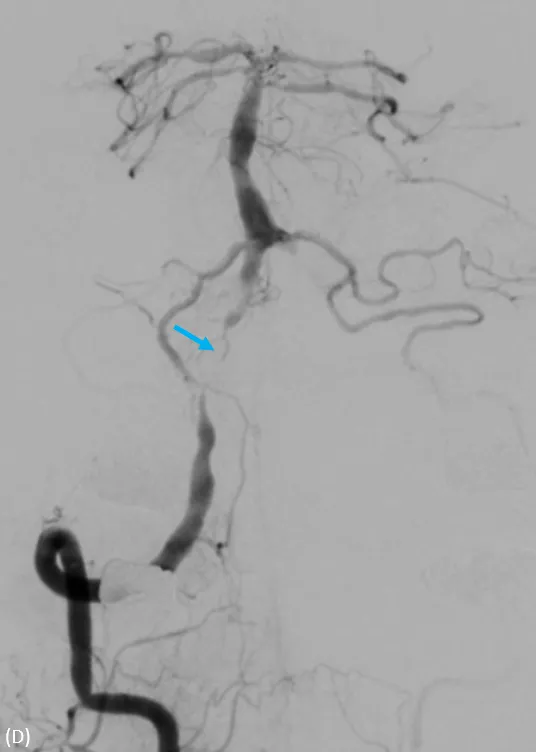 動脈穿刺血管攝影，兩側椎動脈完全阻塞，經由細小分枝供應腦幹的血流。大里仁愛醫院提供 