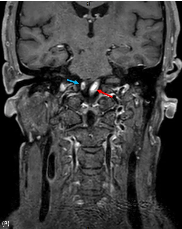 核磁共振高解析度黑血影像，血管有亞急性血栓。大里仁愛醫院提供