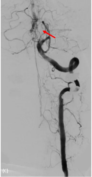 動脈穿刺血管攝影，兩側椎動脈完全阻塞，經由細小分枝供應腦幹的血流。大里仁愛醫院提供