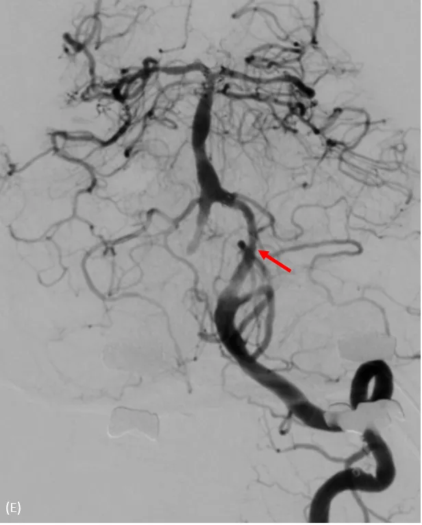支架置放於左側椎動脈後，血流改善許多。大里仁愛醫院提供