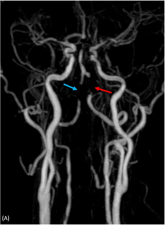 核磁共振血管攝影，顱內左（紅色箭頭）及右（藍色箭頭）椎動脈高度狹窄或是完全阻塞。大里仁愛醫院提供