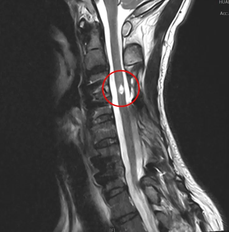 邱先生頸椎脊髓損傷，透過電刺激器協助他站立時的穩定性，現在已經可以獨自一人自由行動。花蓮慈濟醫院提供