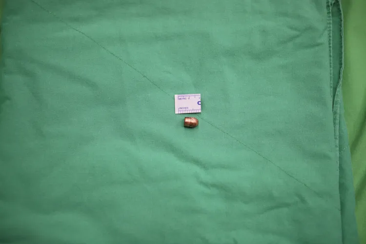 子彈取出。翻攝照片