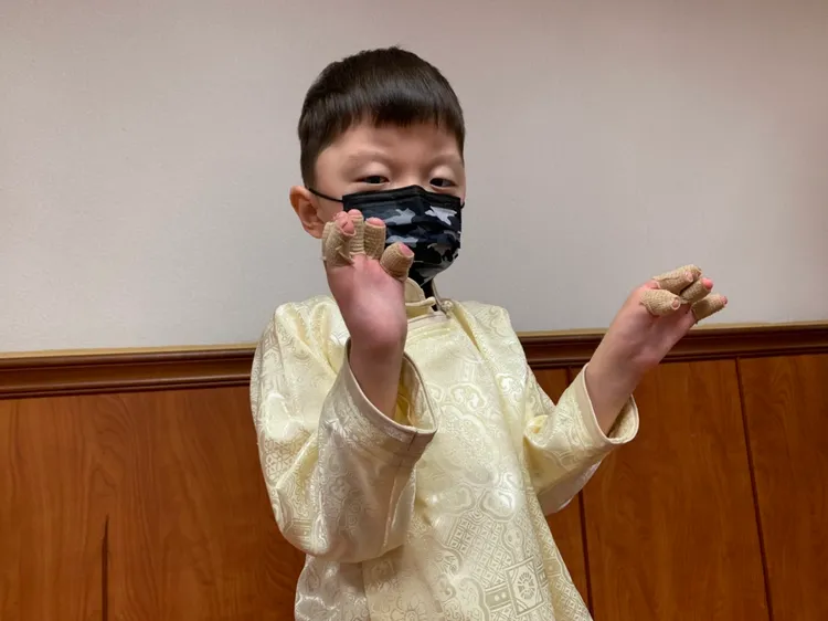 長二:罹患「亞伯氏症」的男童Ochir在高長進行手腳指分離手術後，術後恢復良好，明天將返回蒙古。吳慧芬攝