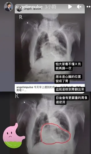 姜冠宇以紅圈解釋，「原本是心臟的位置，變成了胃」。翻攝自姜冠宇IG