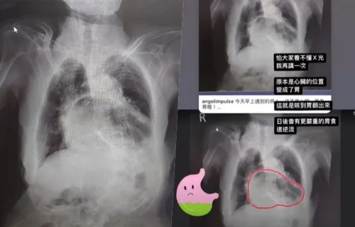 「咳到胃翻出來」是真的！醫師曝X光：這不是心臟，而是胃