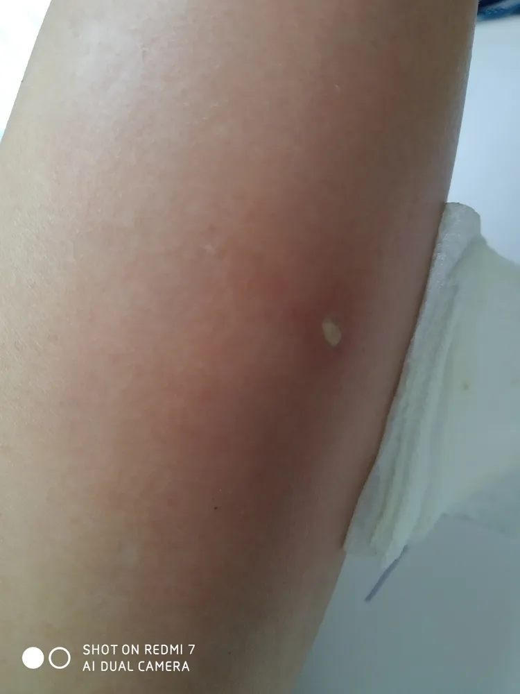 蜂螫的傷口原本不明顯。郭小姐提供