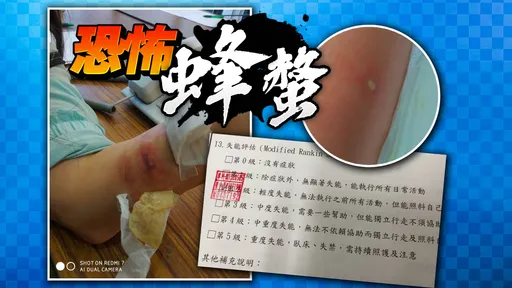 獨家|工作蜂螫左手失能 派遣工悲歌!只獲1460元醫藥費還丟工作