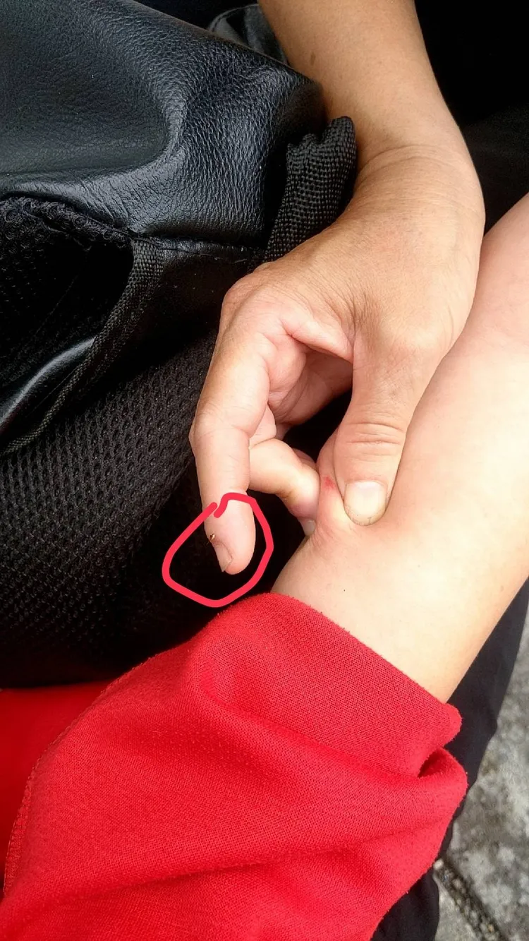 郭小姐手指擠壓處為蜂螫的傷口，蜂針則留在紅圈處。郭小姐提供