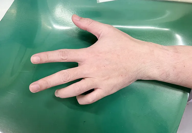 35歲男子天天瘋手遊，打到左手麻痛變形「鷹爪手」才趕快就醫。中港澄清醫院提供