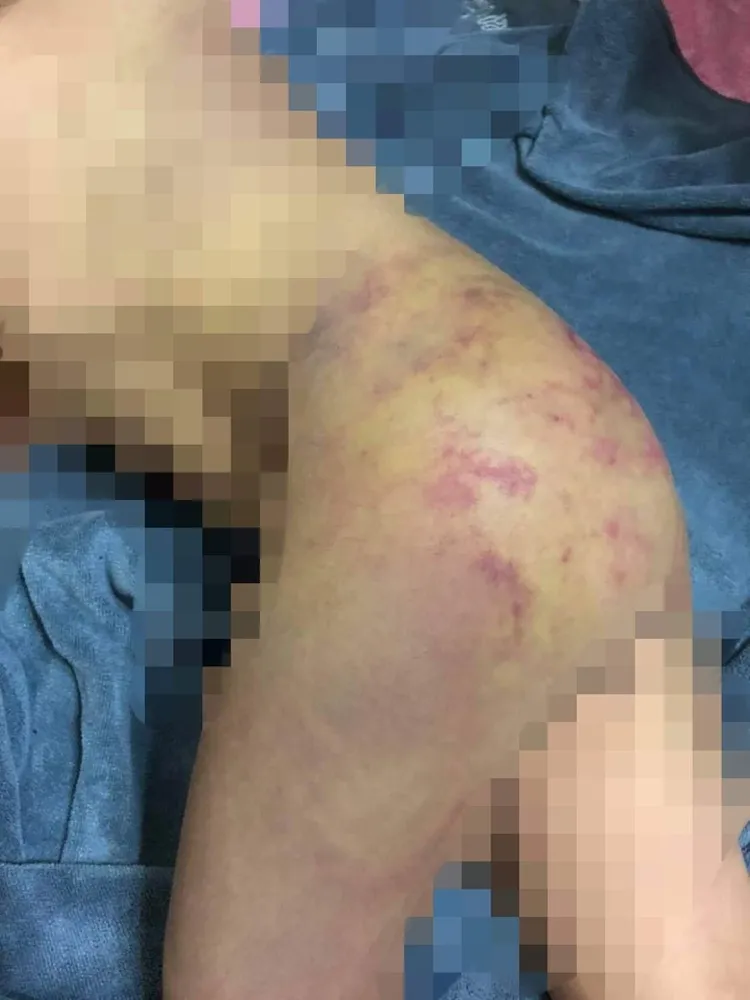 被害男童臀部被打到滿是瘀青、紅腫。翻攝爆料公社