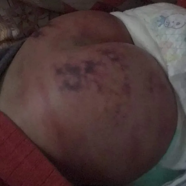 男童臀部傷勢令心看了不忍。翻攝爆料公社