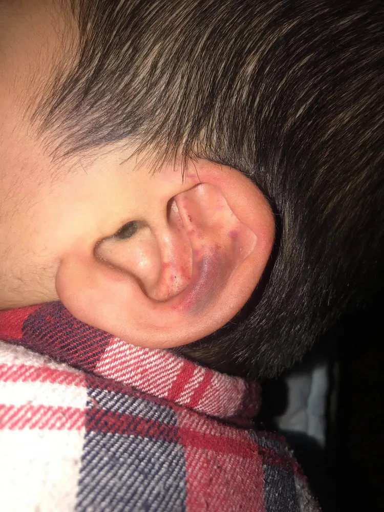 男童耳朵部位也有傷痕，但無法認定是陳男造成。翻攝爆料公社