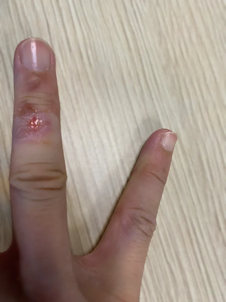 胡宇威因為煎牛排受傷，目前已好得差不多。寶麗來提供