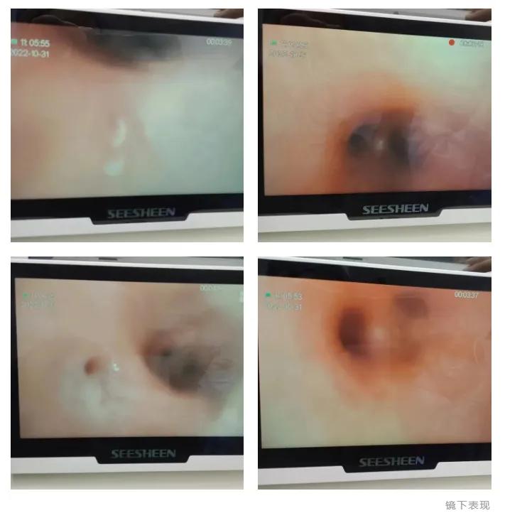 女童氣管壁黏膜十分粗糙，紅腫明顯。翻攝微博