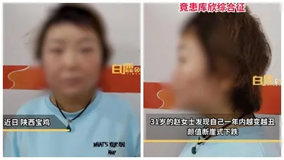 突然變醜不是進廠維修失敗! 中國31歲女子顏值暴跌竟是罕病纏身