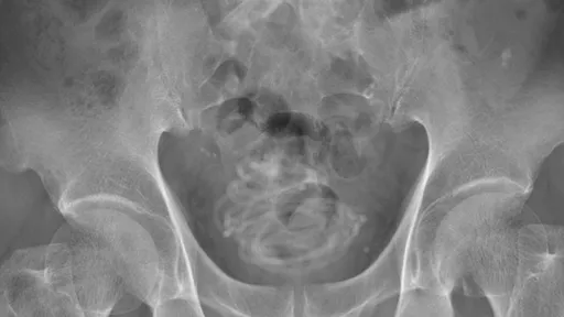 阿伯「229公分跳繩塞入陰莖」　在膀胱打結讓醫師都傻眼