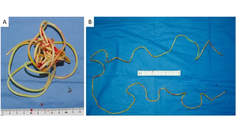 被取出的跳繩。翻攝自《每日星報》