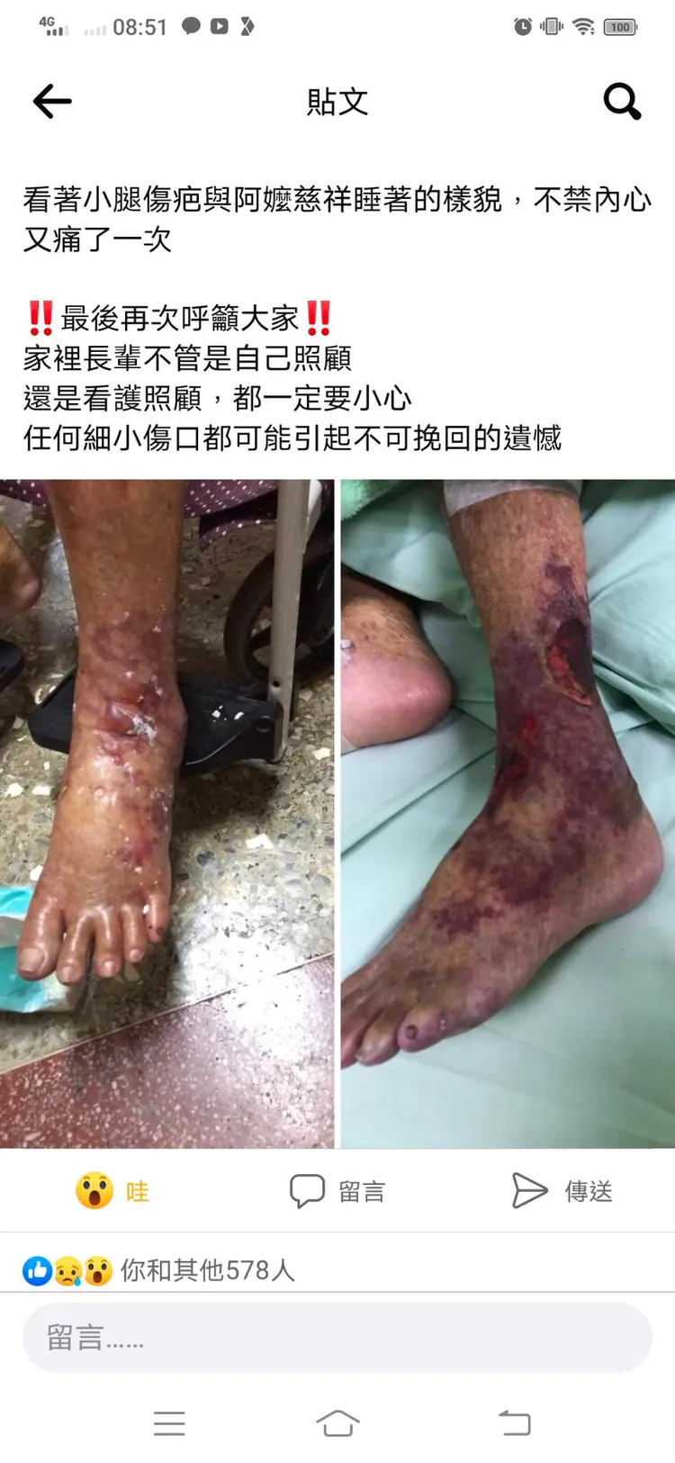 九旬阿嬤因小腿遭燙傷傷口感染引發敗血症，造成猝死的憾事。翻攝爆料公社