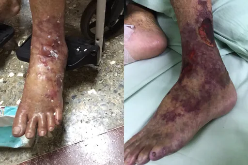 长照员到府洗澡！九旬嬷烫伤起水泡　恶化成蜂窝性组织炎2天猝逝