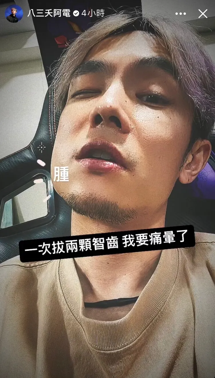 阿電曬出半邊腫臉。翻攝阿電ig限動