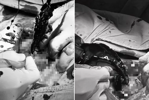 孕婦大出血!下刀像挖破石油管「黑血噴臉」 台大仁醫驚:胎兒糟了
