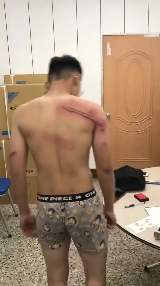 劉姓學生全身都是被棍棒毆打的傷痕。讀者提供