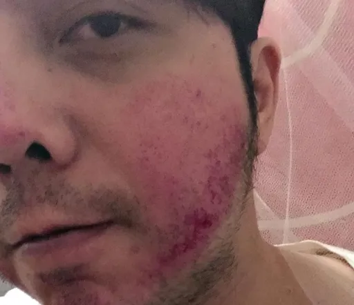 小炳為已故大炳和陌生人打架 臉腫成豬頭