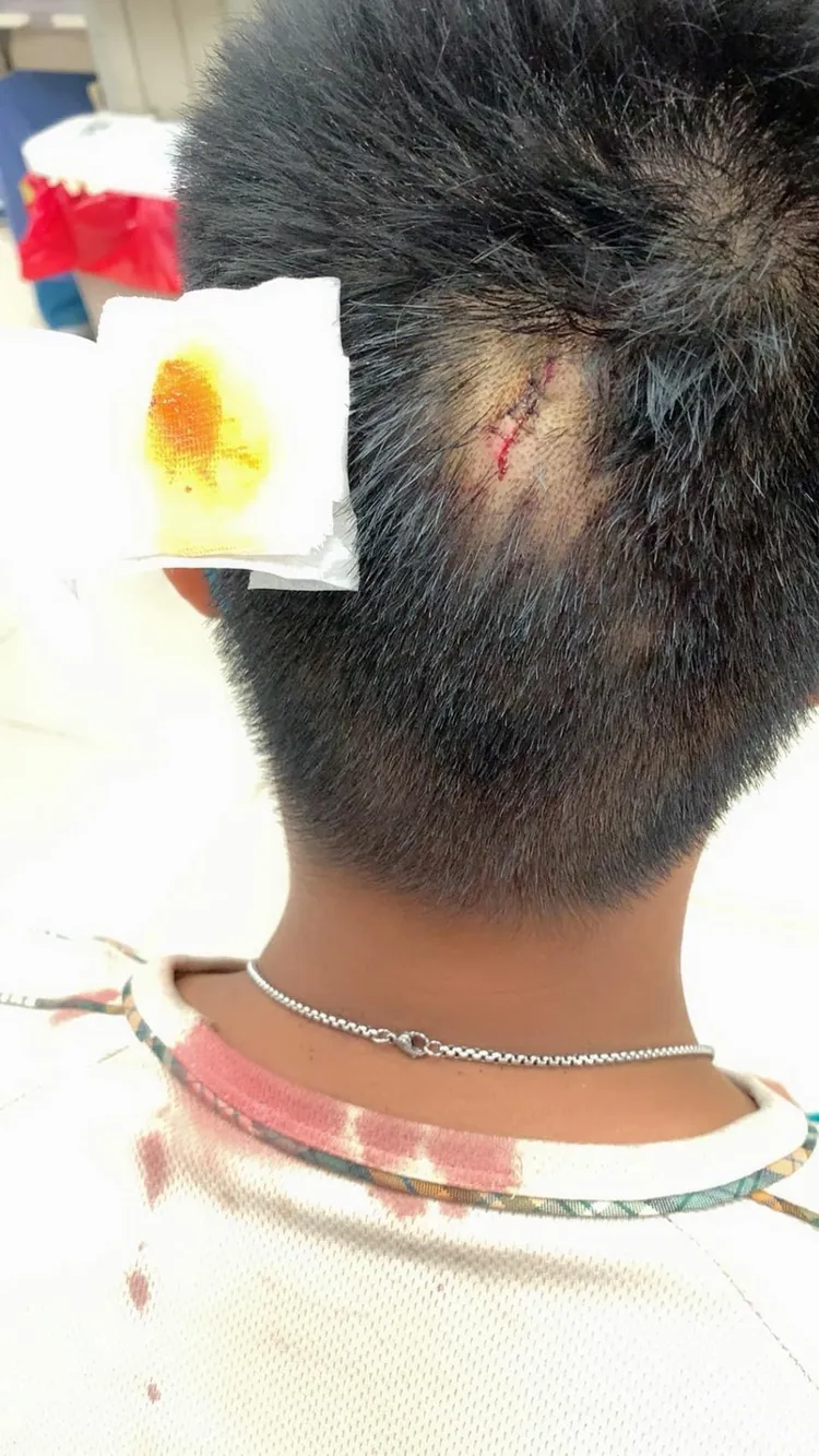 有網友貼出就讀國中孩子在學校被打破頭照。翻攝自臉書社團高雄五甲大小事