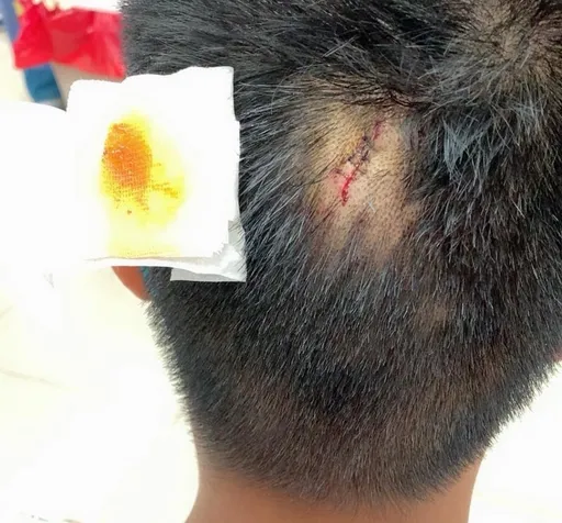 高雄國中生誤踩同學眼鏡遭手機爆頭 濺血縫3針!母控訴太殘忍